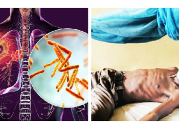 TB: A Preventable Disease Still Killing Nigerians