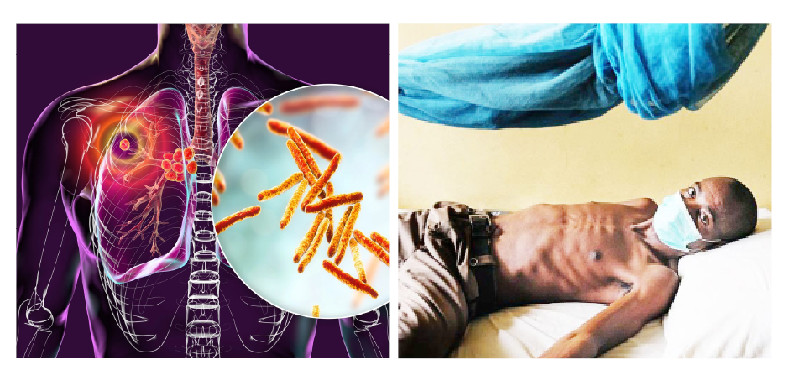 TB: A Preventable Disease Still Killing Nigerians