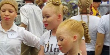 Albinism: Nigeria’s Invisible Millions 4 Albinism: Nigeria’s Invisible Millions