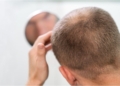 The Most Common Type Of Hair Loss In India and How To Treat It