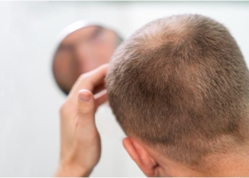 The Most Common Type Of Hair Loss In India and How To Treat It