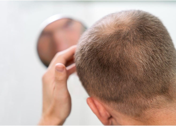 hair loss in india