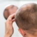 The Most Common Type Of Hair Loss In India and How To Treat It