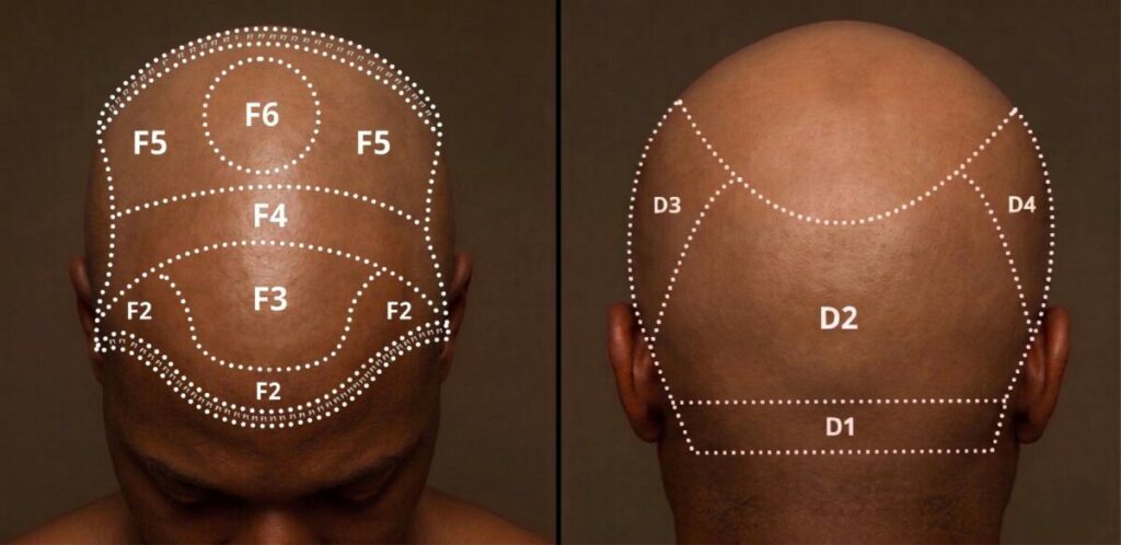 #1 Istanbul Vita | Best Afro Hair Transplant Clinic in 2026 4 hair transplant