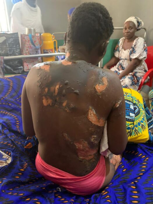 Man Arrested For Allegedly Setting Wife Ablaze In Kogi