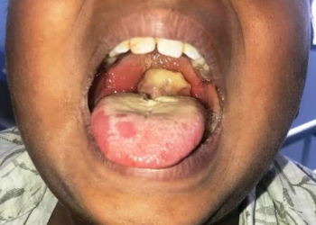 Diphtheria Outbreak Worsens In Katsina