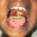 Diphtheria Outbreak Worsens In Katsina