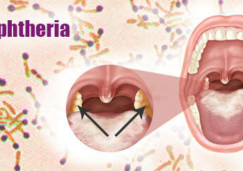 Diphtheria: Everything You Need To Know As Nigeria Battles Fresh Outbreak