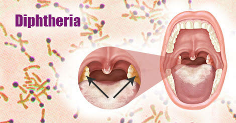 Diphtheria: Everything You Need To Know As Nigeria Battles Fresh Outbreak 1 IMG 0419