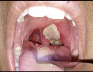 Diphtheria Outbreak: What Nigerians Need To Know As Cases, Deaths Rise (2) 2 IMG 3278
