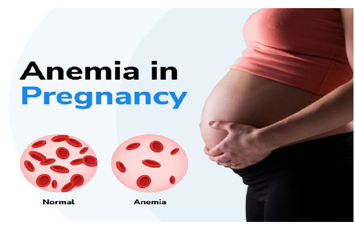 How MMS Stockouts Are Fuelling Nigeria’s Maternal Anaemia Burden 1 MMS stockout 1