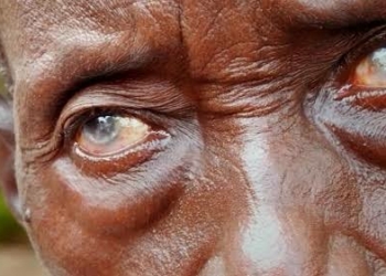 Sight Loss: 84% Of 24m Cases In Nigeria Preventable — OSN
