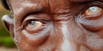 Sight Loss: 84% Of 24m Cases In Nigeria Preventable — OSN