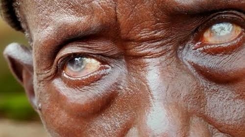 Sight Loss: 84% Of 24m Cases In Nigeria Preventable — OSN 1 images 2026 09 09T072849.715