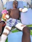 Taraba Student Who Lost Both Hands To Electrocution Risks Losing Sight,Seeks Help