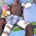 Taraba Student Who Lost Both Hands To Electrocution Risks Losing Sight,Seeks Help