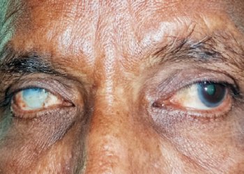 Beyond Free Screening: Nigeria’s Search For Sustainable Eye-Care Funding