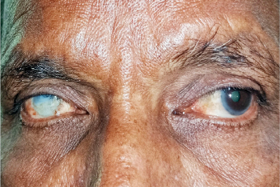 Nigeria's Vision for Eye Care: A Desperate Search for Sustainable Funding Beyond Freebies